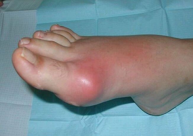 Klinický obraz artritidy nohy - otok a zánět