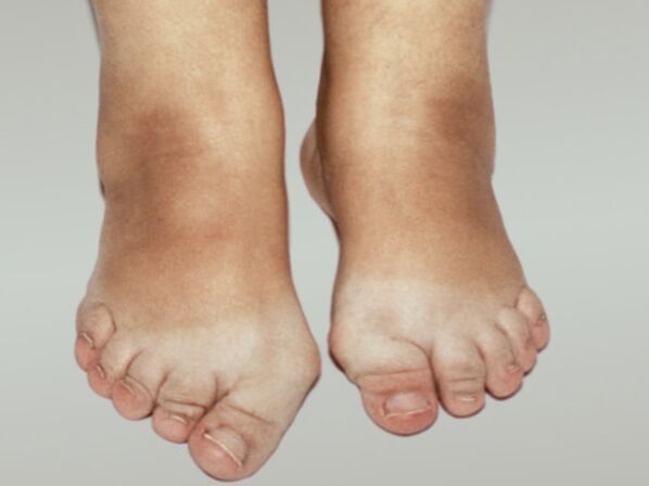 Osteoartróza nohy s těžkou deformací prstů