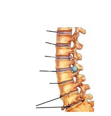 stádia vývoje osteochondrózy