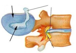 zničení vláknitého prstence u cervikální osteochondrózy