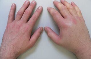 artralgie jako příčina bolesti kloubů prstů