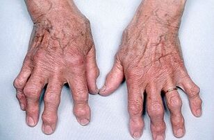 jak se zbavit bolesti kloubů prstů