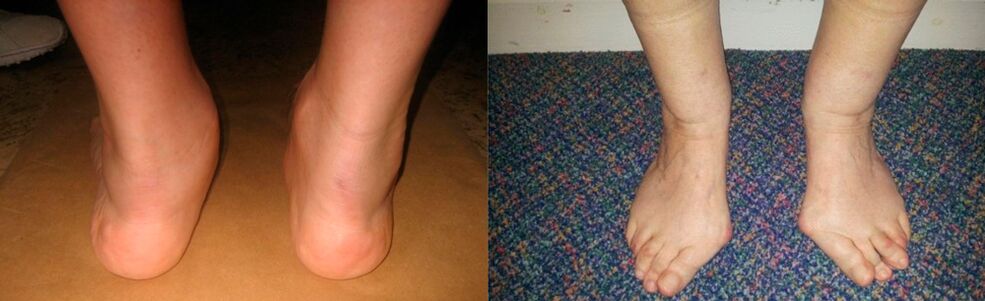 Artróza palce nohy a deformující artróza kotníku
