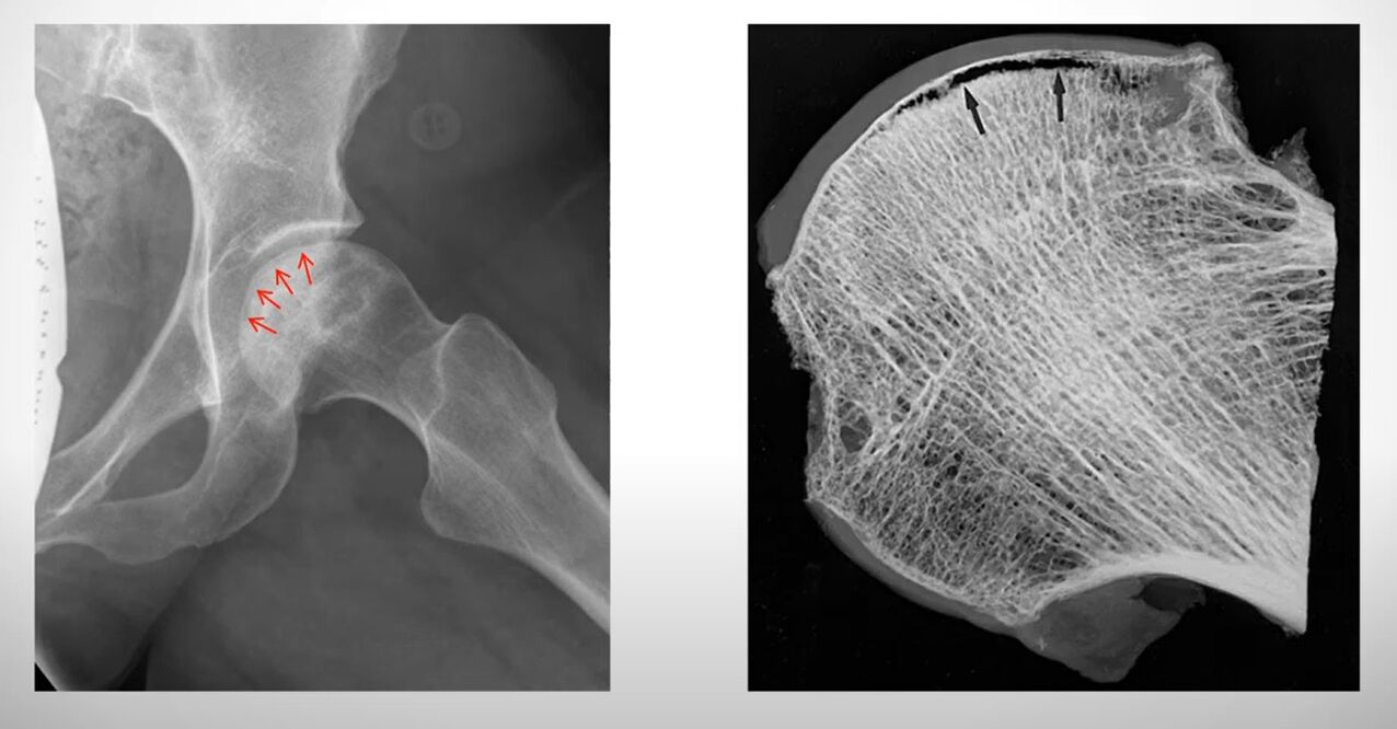 Rentgenový snímek hlavice stehenní kosti postižené aseptickou nekrózou