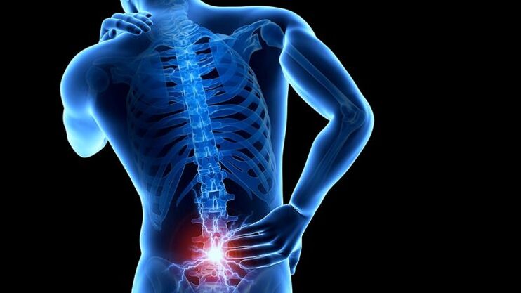 bolesti zad s bederní osteochondrózou